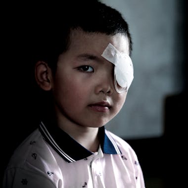 Young Boy With Eye Patch China