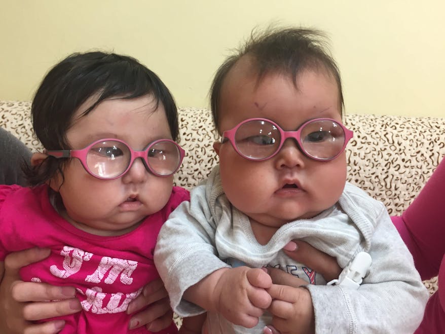 At 42 days old, Marla became the youngest person in Mongolia to receive cataract surgery